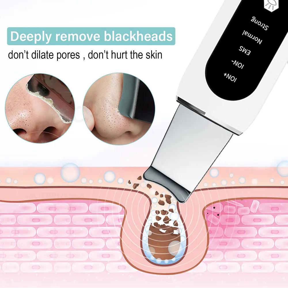 Ultrasonic Skin Scrubber Blackhead & Pore Cleaner by HitMyNeed