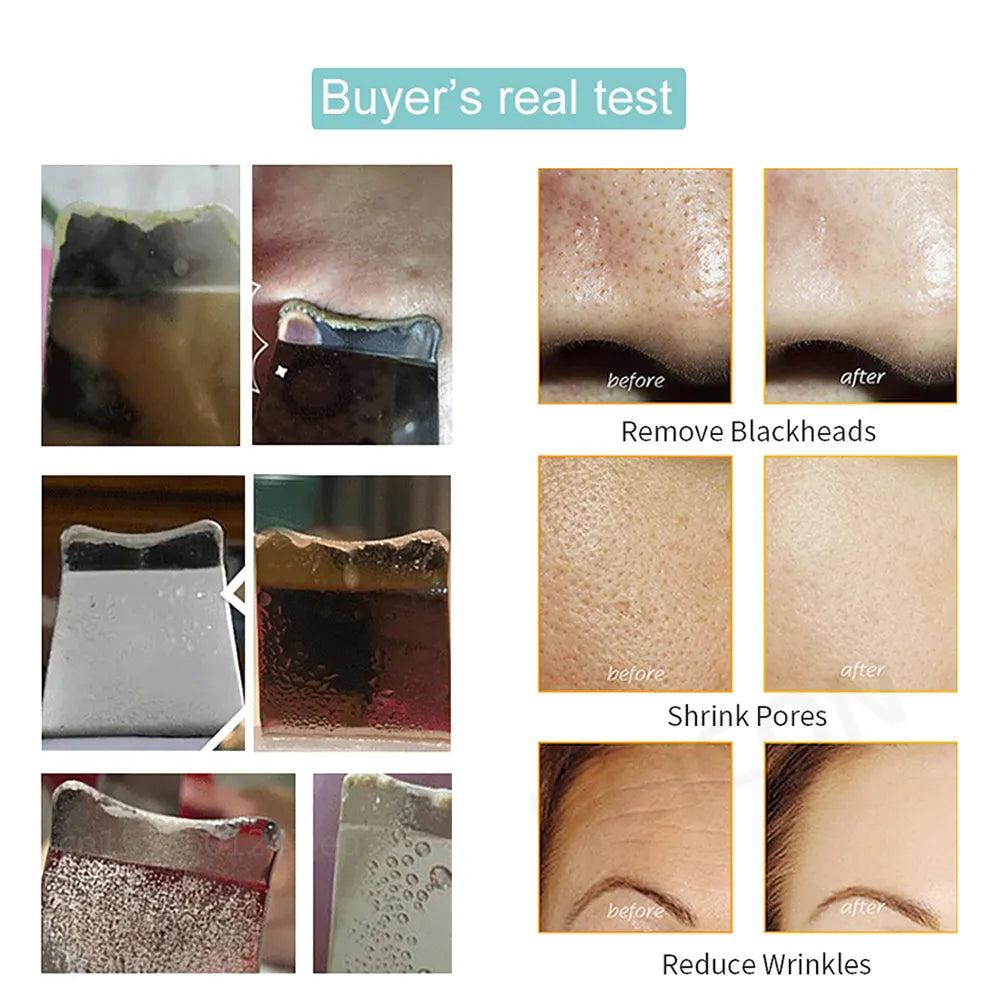 Ultrasonic Skin Scrubber Blackhead & Pore Cleaner by HitMyNeed