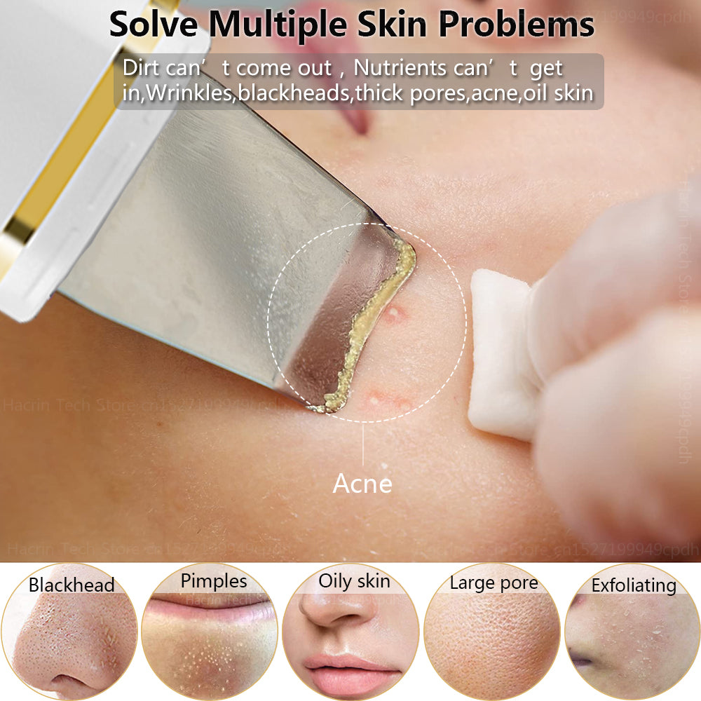 Ultrasonic Skin Scrubber Blackhead Remover by HitMyNeed