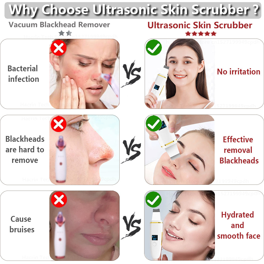 Ultrasonic Skin Scrubber Blackhead Remover by HitMyNeed