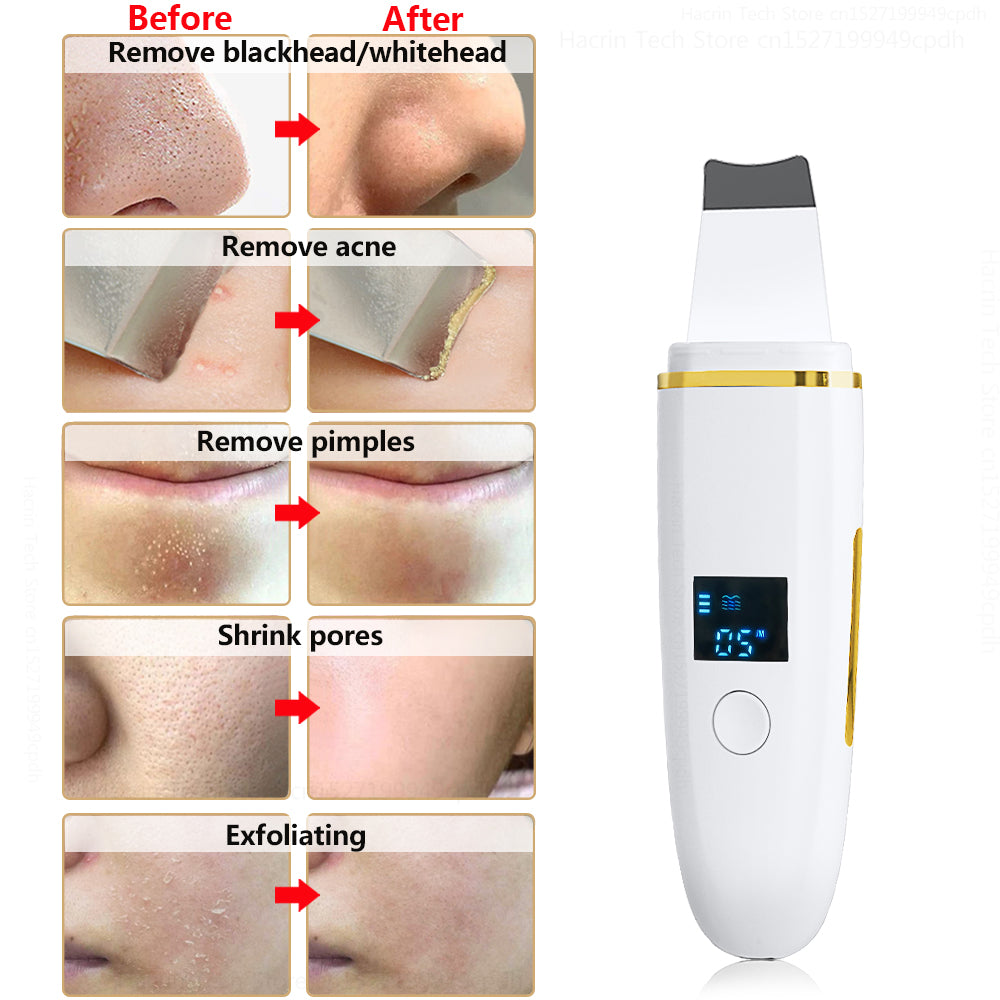 Ultrasonic Skin Scrubber Blackhead Remover by HitMyNeed