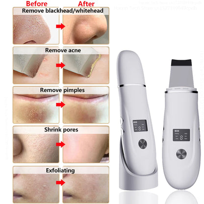 Ultrasonic Skin Scrubber with EMS Lifting by HitMyNeed