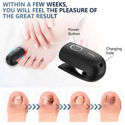USB Rechargeable Nail Fungus Laser Therapy Device by HitMyNeed