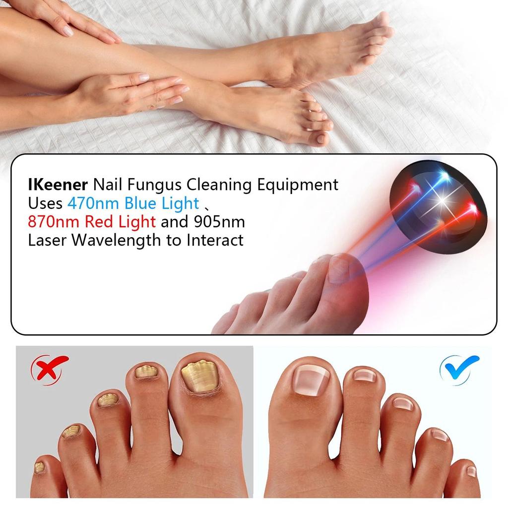 USB Rechargeable Nail Fungus Laser Therapy Device by HitMyNeed