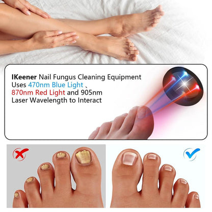 USB Rechargeable Nail Fungus Laser Therapy Device by HitMyNeed