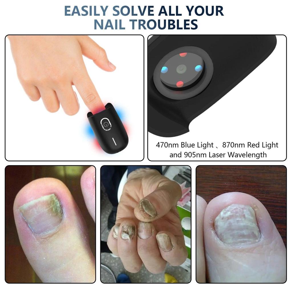 USB Rechargeable Nail Fungus Laser Therapy Device by HitMyNeed