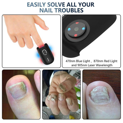 USB Rechargeable Nail Fungus Laser Therapy Device by HitMyNeed