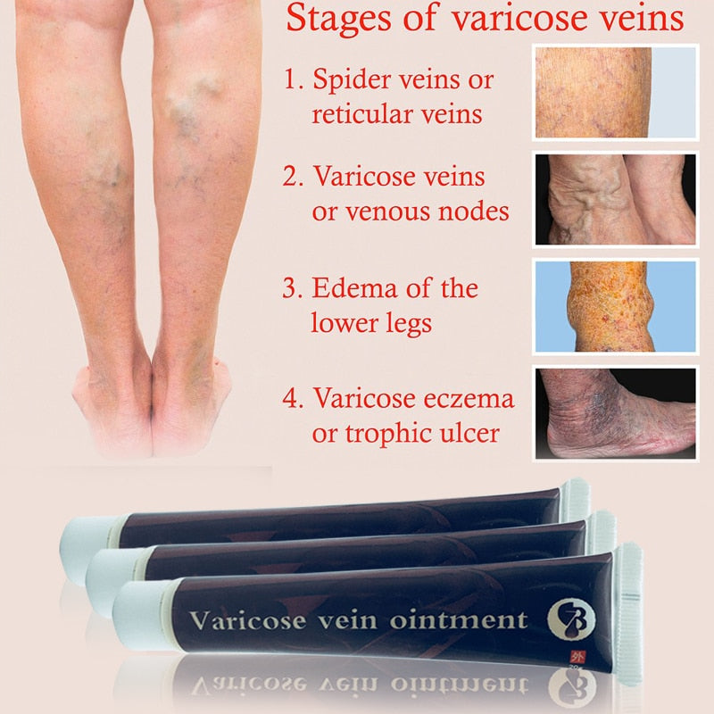 Varicose Vein Relief Herbal Cream Ointment 20g by HitMyNeed
