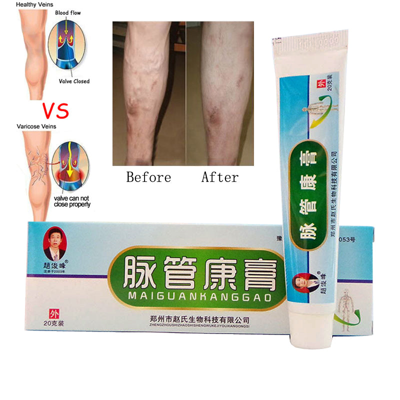 Varicose Veins Treatment Ointment by HitMyNeed