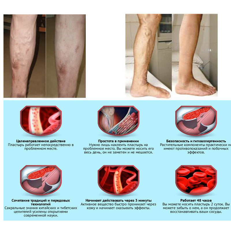 Varicose Veins Treatment Ointment by HitMyNeed