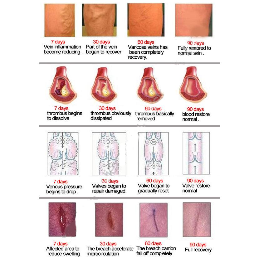 Varicose Veins Treatment Ointment by HitMyNeed