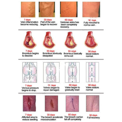 Varicose Veins Treatment Ointment by HitMyNeed