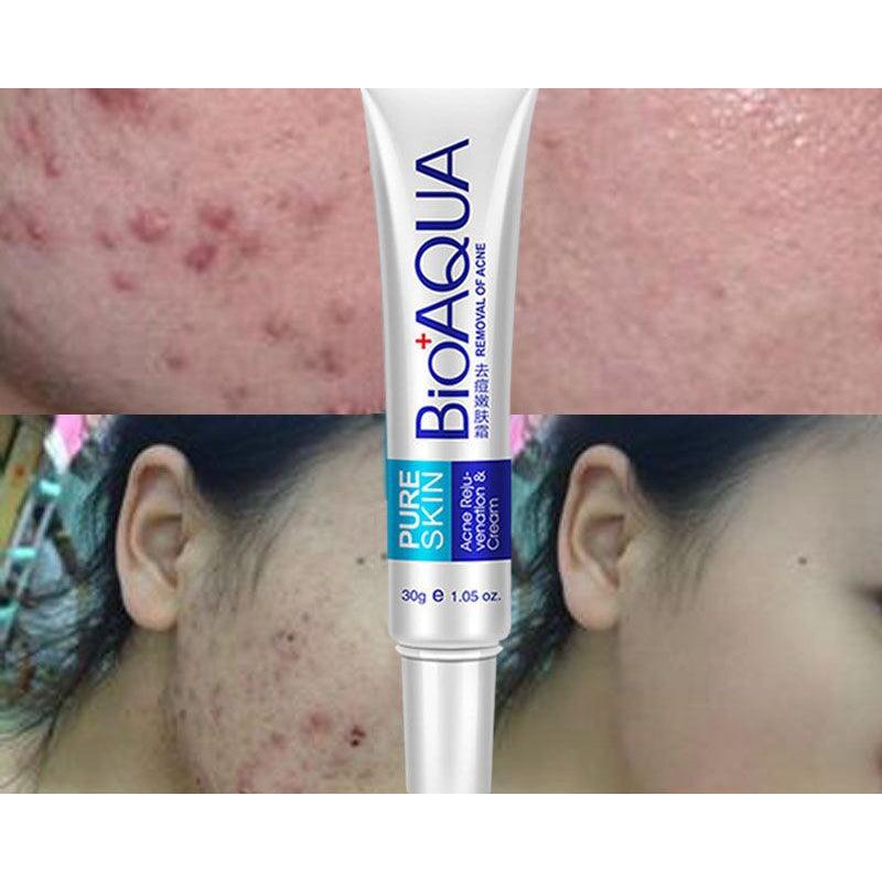 Whitening Cream Acne Treatment for Clearer Skin by HitMyNeed